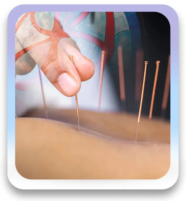 Acupuntura
